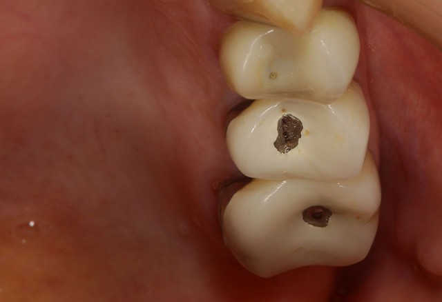 すり減っ た 歯 修復