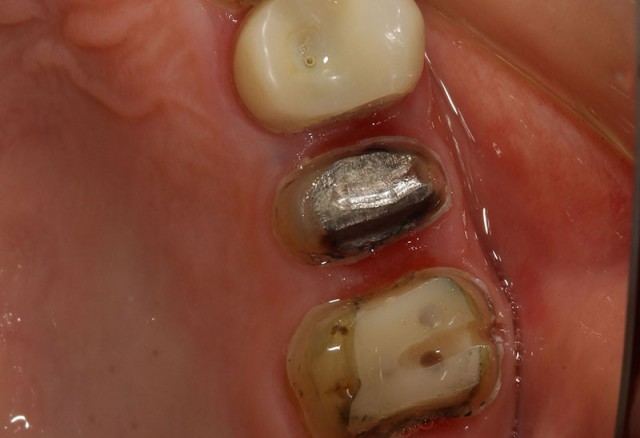 すり減っ た 歯 再生