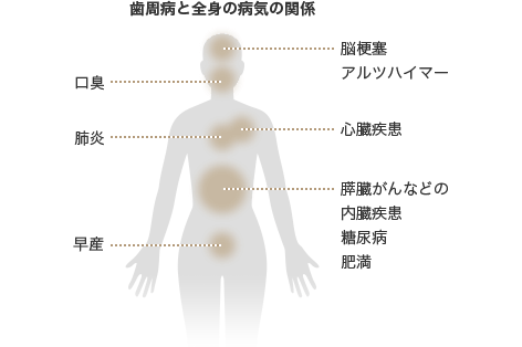 歯周病による病気のリスク