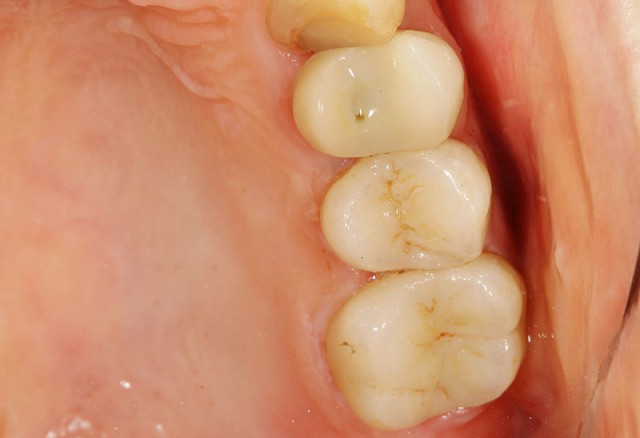 すり減っ た 歯 再生