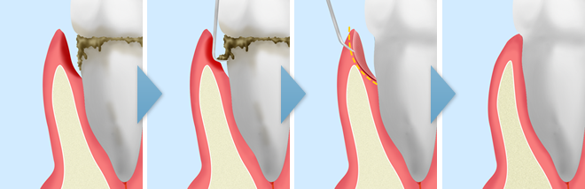 歯周ポケットそうは術