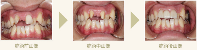 セラミックブリッジ施術例1