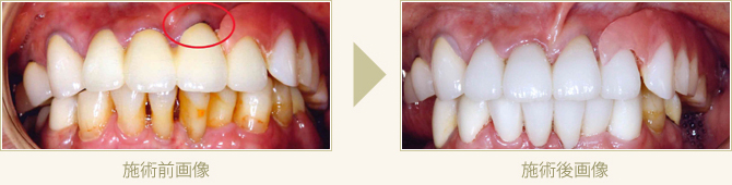 差し歯の付け根の黒ずみと歯茎の下がりを セラミッククラウンにて審美回復した症例