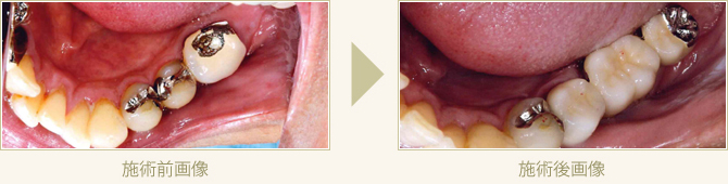 奥歯のブリッジが折れセラミックで審美回復した症例