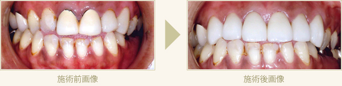 変色した保険のかぶせを自費のオールセラミックで審美回復した症例1