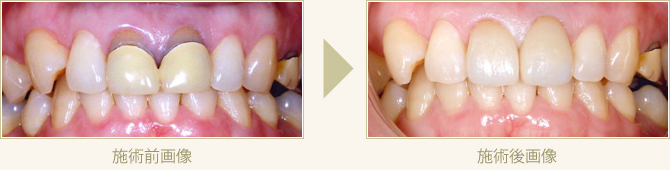 変色した保険のかぶせを自費のオールセラミックで審美回復した症例2