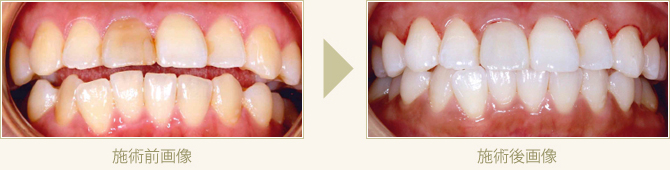 変色した前歯をオールセラミッククラウンで審美回復しホワイトニングした症例