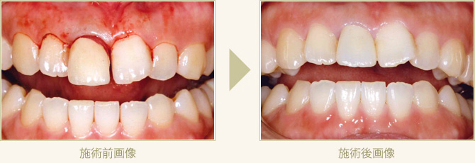 何度も外れるラミネートべニアをセラミッククラウンにやり変えた症例