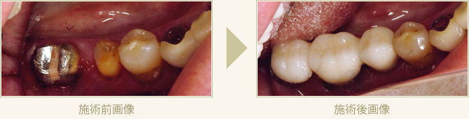オールセラミックで審美回復した症例