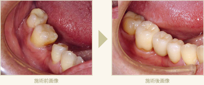 欠損した歯にジルコニアブリッジを入れた症例