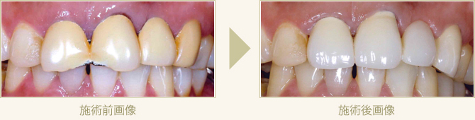 かけてしまったかぶせ物を保険適応により作りなおした症例