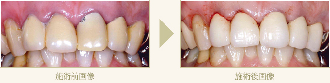 変色した保険適応のかぶせ物を作り直した症例