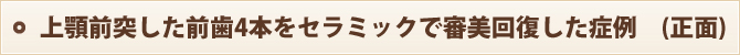 上顎前突した前歯4本をセラミックで審美回復した症例 (正面)